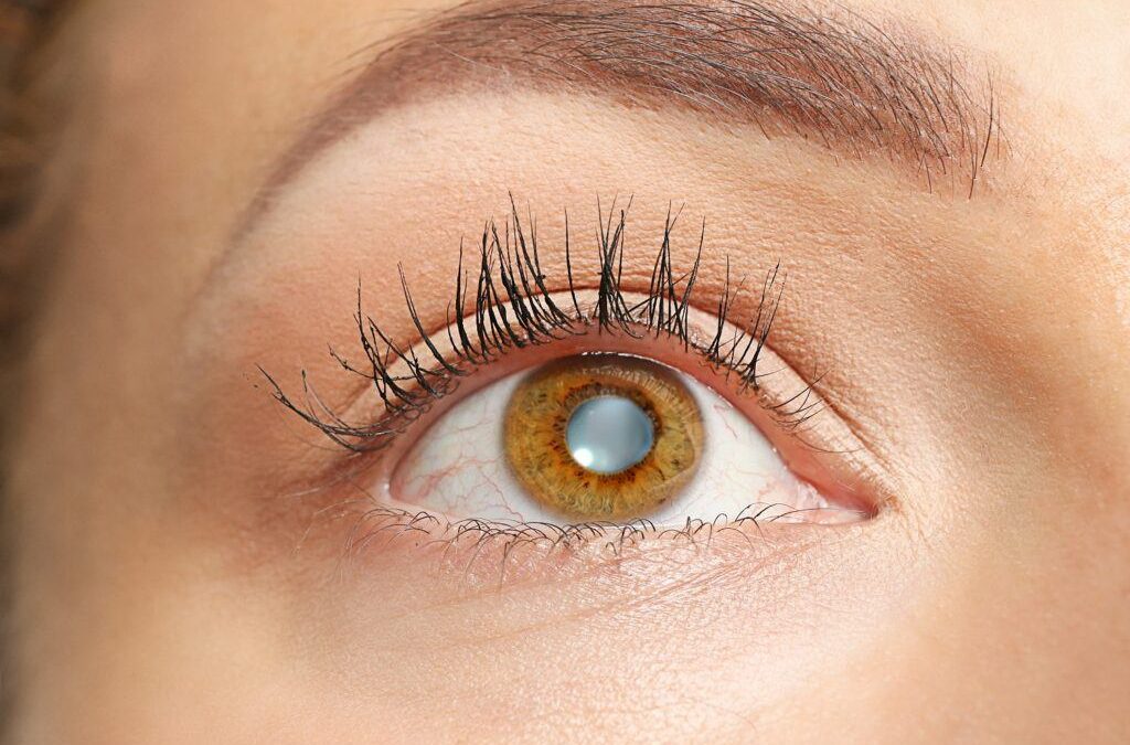 Cataracts